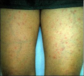 患者の脚に見られた無数の発疹の写真