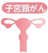 子宮頸がん