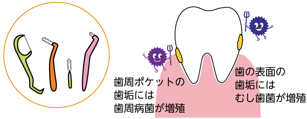 デンタルフロスや歯間ブラシタフトブラシのイラスト、歯のイラスト 歯周ポケットの歯垢には歯周病菌が増殖 歯の表面の歯垢にはむし歯菌が増殖